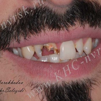 Восстановление переднего зуба после травмы