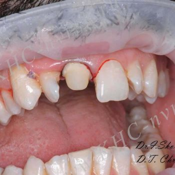 Восстановление переднего зуба после травмы