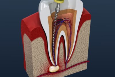 Лечение каналов зуба (эндодонтия)